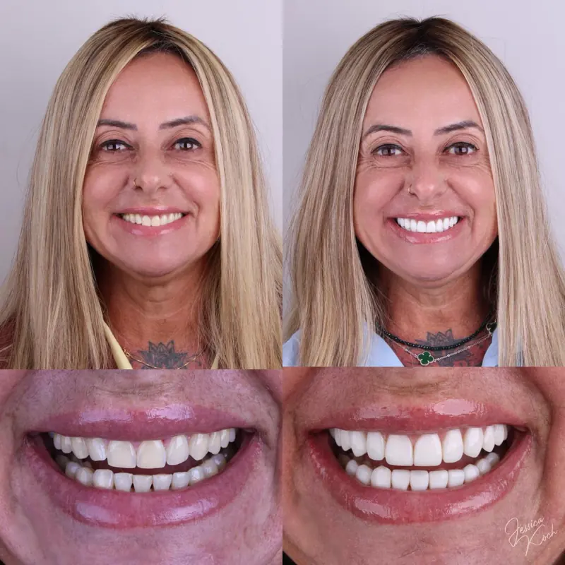 Antes e depois de paciente com lentes superiores e inferiores: rosto e sorriso antes, à esquerda, e depois, à direita