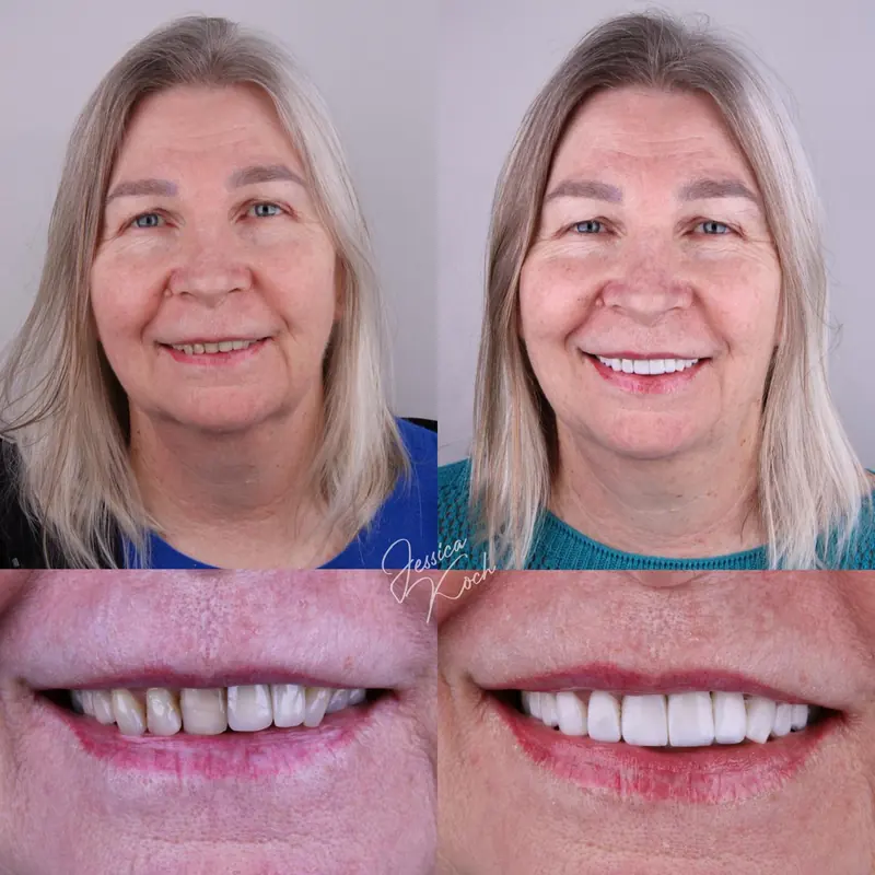 Antes e depois do sorriso de paciente: rosto e sorriso antes, à esquerda, e depois, à direita
