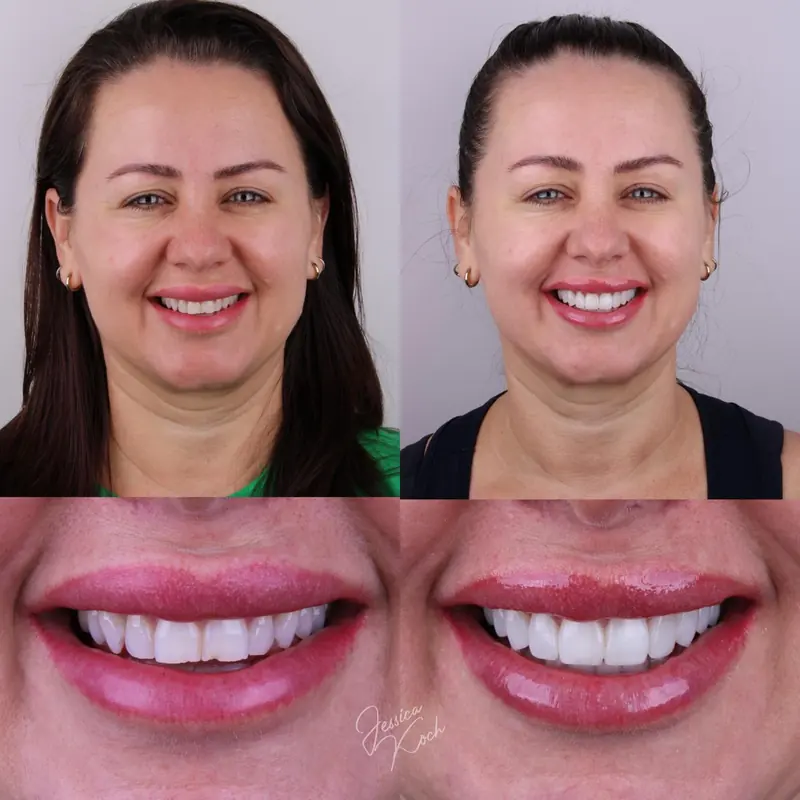 Antes e depois do sorriso de paciente: rosto e sorriso antes, à esquerda, e depois, à direita