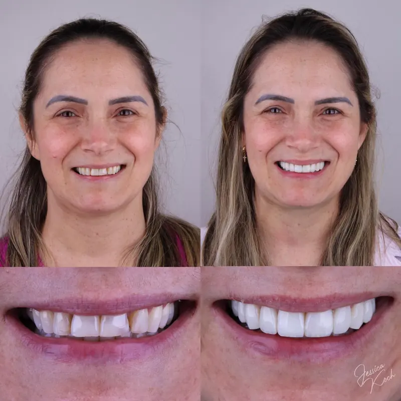 Antes e depois do sorriso de paciente: rosto e sorriso antes, à esquerda, e depois, à direita