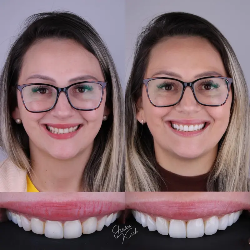 Antes e depois de troca de lentes antigas por lentes novas feitas pela Dra. Jessica