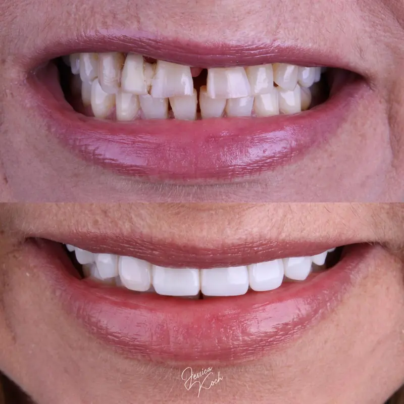 Close do sorriso antes e depois: acima, os dentes antes; abaixo, com lentes nos dentes superiores