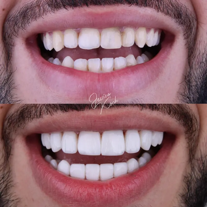 Close do sorriso antes e depois de lentes superiores e inferiores em cor mais branca