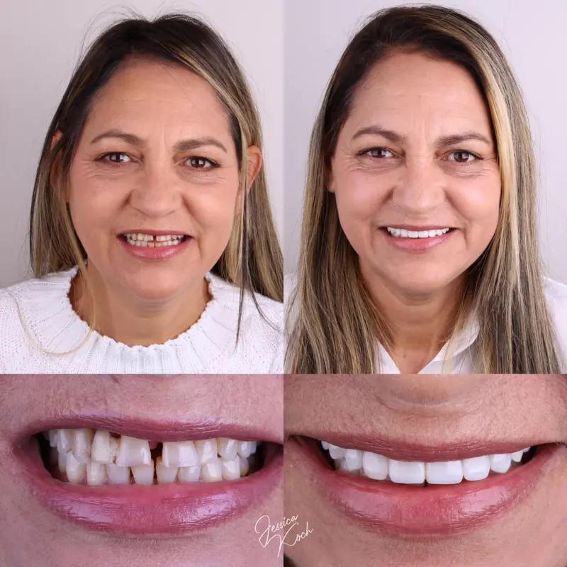 Antes e depois de paciente com lentes em resina superiores: rosto e sorriso antes, à esquerda, e depois, à direita