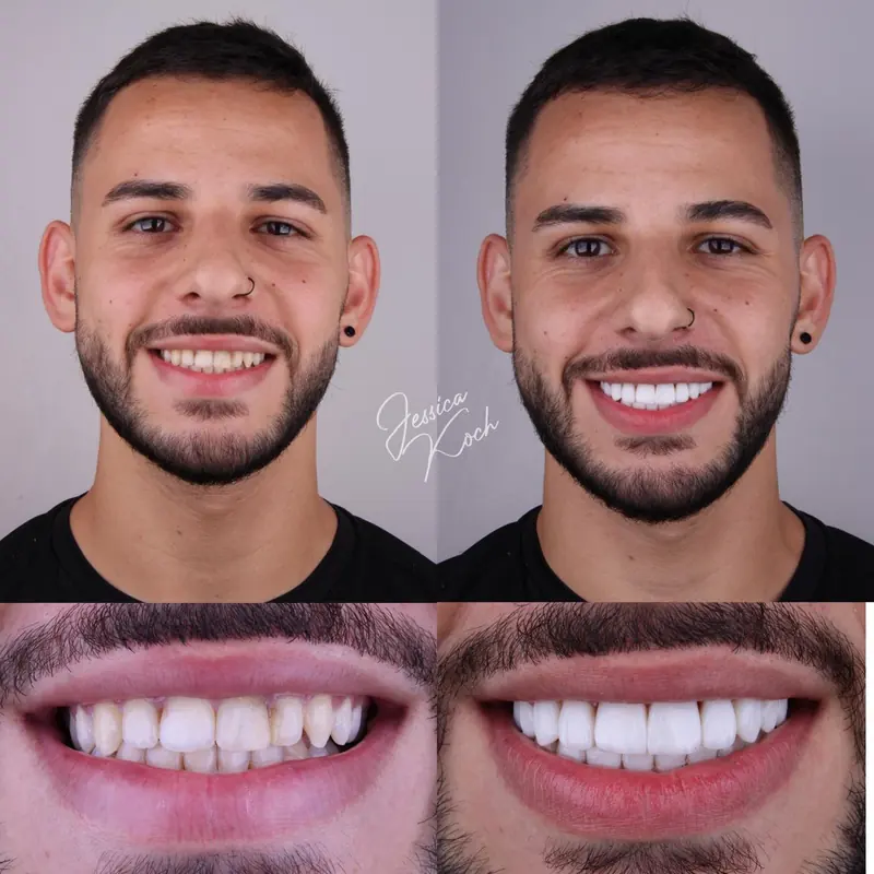 Antes e depois de paciente com lentes em resina: rosto e sorriso antes, à esquerda, e depois, à direita