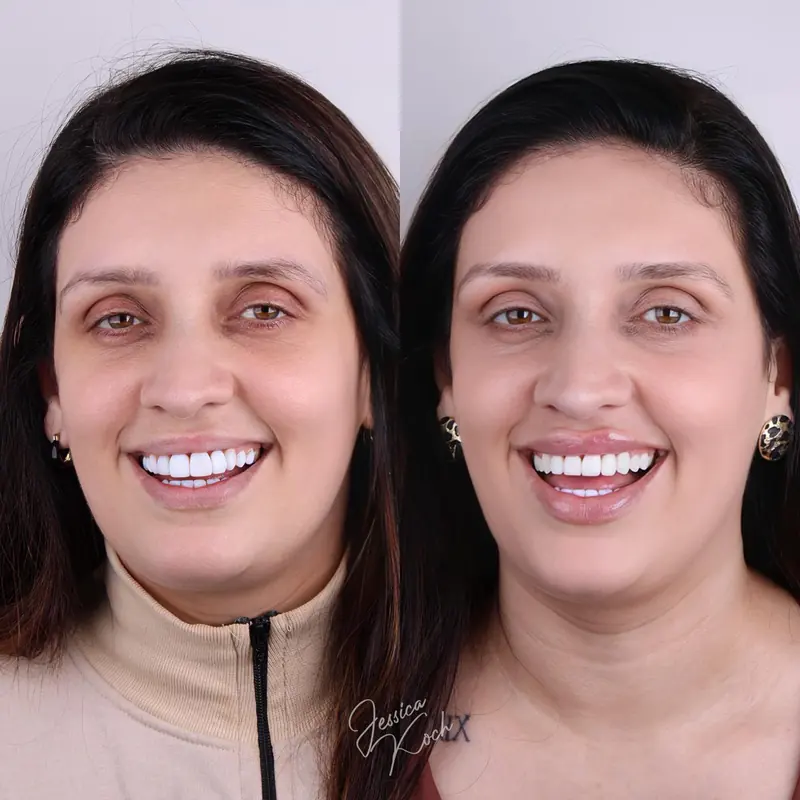 Antes e depois de paciente que refez lentes antigas: à esquerda, as lentes anteriores; à direita, as novas, mais finas