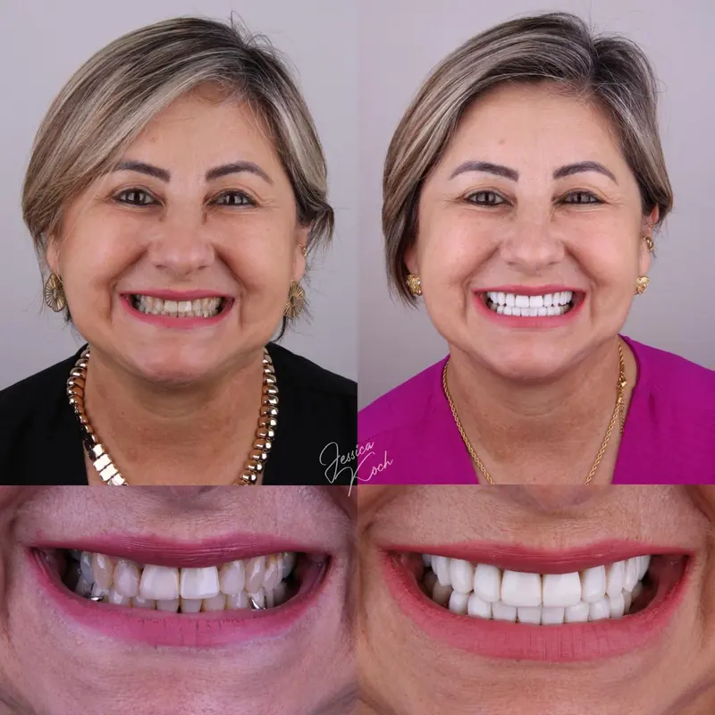 Antes e depois do sorriso de paciente: rosto e sorriso antes, à esquerda, e depois, à direita