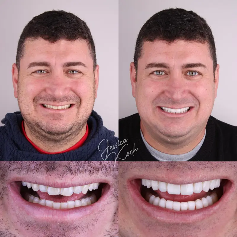 Antes e depois do sorriso de paciente: rosto e sorriso antes, à esquerda, e depois, à direita
